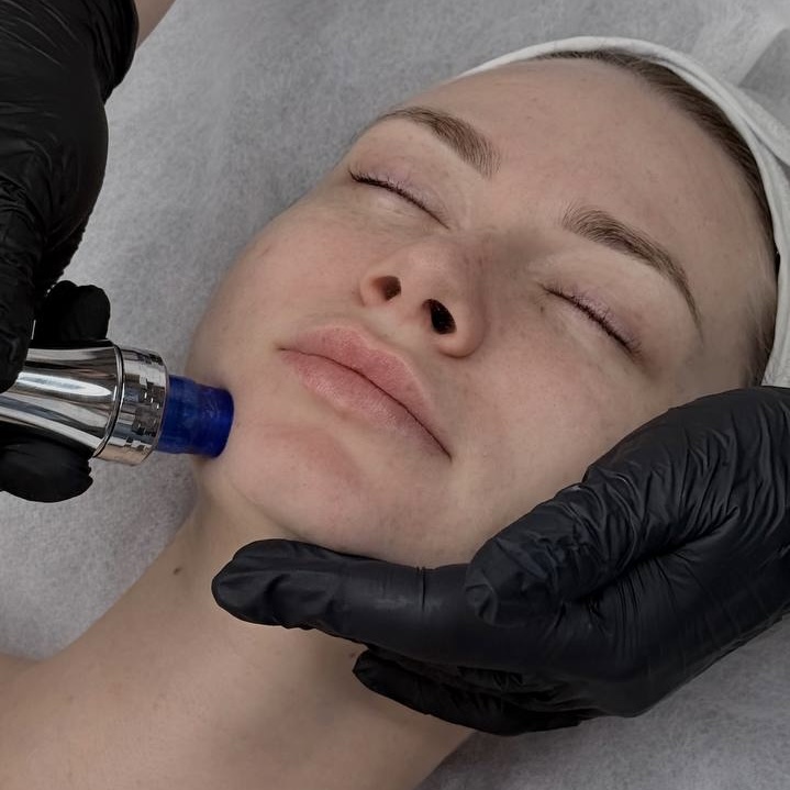Microdermabrasion